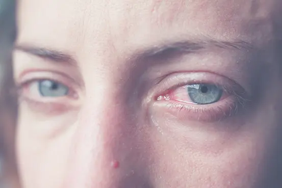 Göz nezlesine karşı 7 etkili öneri!