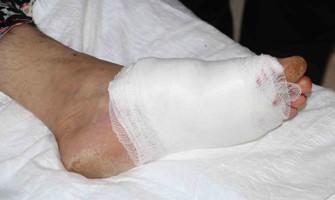 Diyarbakır’daki yanık ünitesi, kronik yara birimi bölgedeki hastalara umut oluyor